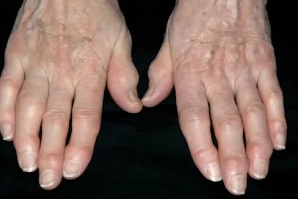 Artrose nas Mãos